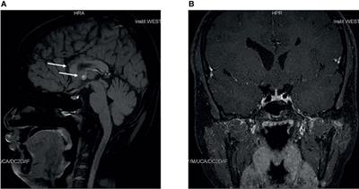 Case Report: A Novel Point Mutation of SOX3 in a Subject With Growth Hormone Deficiency, Hypogonadotrophic Hypogonadism, and Borderline Intellectual Disability